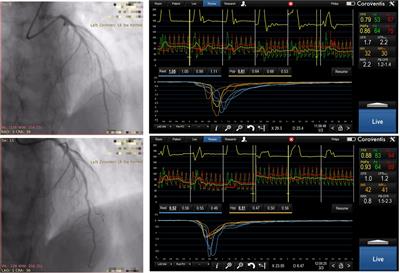The imPAct of Trimetazidine on MicrOcirculation after Stenting for stable coronary artery disease (PATMOS study)